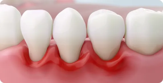 歯周病治療の様子