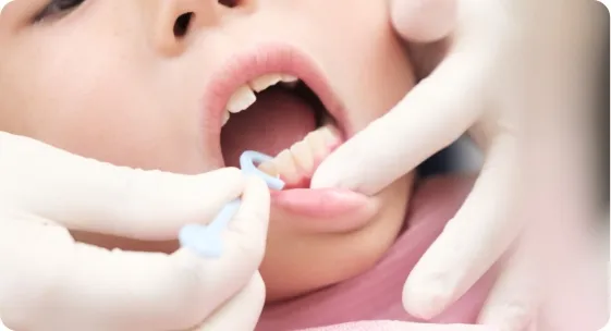 歯石や着色の除去の様子